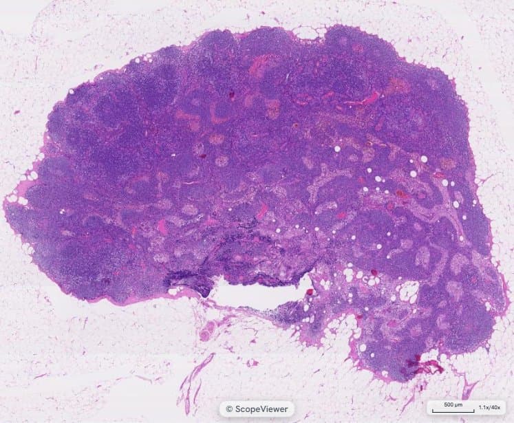 Histology slide of a lymph node, H&E stain